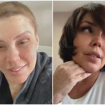 Simony mostra tamanho real do cabelo após tratamento de câncer; fotos