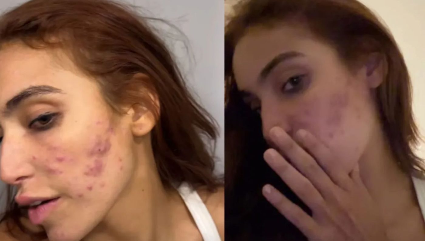 Vanessa Lopes volta a desabafar sobre acne: ‘Autoestima lá em baixo’