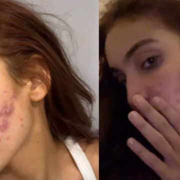 Vanessa Lopes volta a desabafar sobre acne: ‘Autoestima lá em baixo’