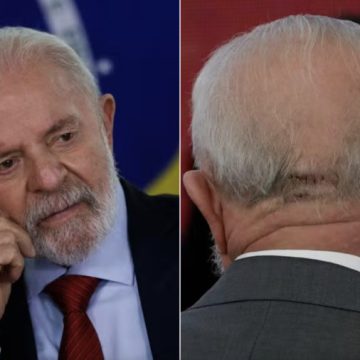 Após acidente doméstico, presidente Lula realiza novos exames e seguirá sem fazer viagens de avião nos próximos dias