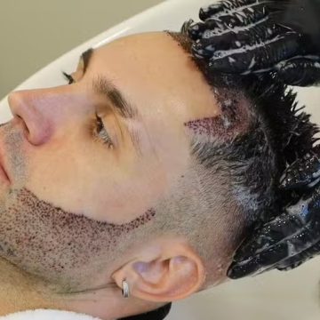 Ex-BBB Arthur Picoli passa por transformação estética com transplante de cabelo e de barba