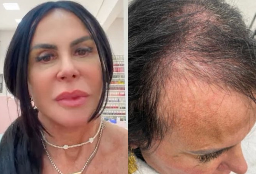 Gretchen mostra o estado de seu cabelo após diagnóstico de alopecia; veja fotos