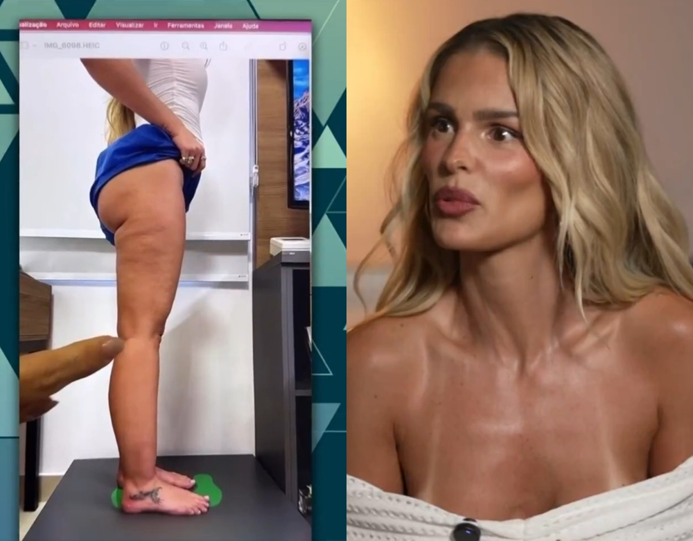 Yasmin Brunet revela que diagnostico de lipedema quase a tirou do BBB 24: ‘Morro de vergonha’