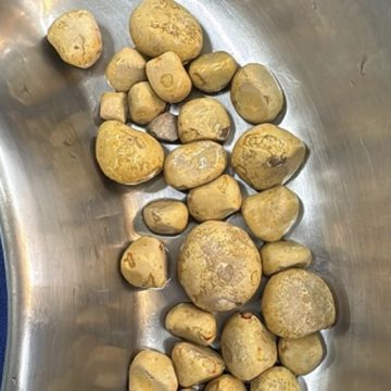 Homem desenvolve 35 pedras na bexiga após beber refrigerante todos os dias