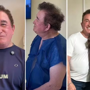 Casado com miss 51 anos mais nova, Amado Batista recorre a transplante capilar