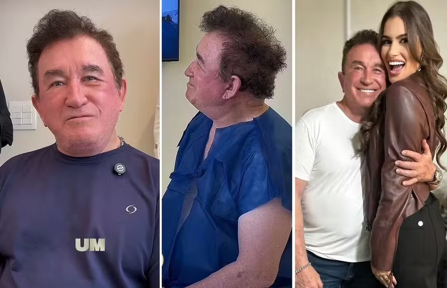 Casado com miss 51 anos mais nova, Amado Batista recorre a transplante capilar