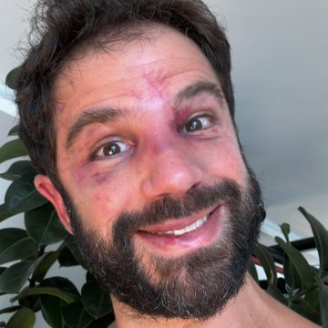 Duda Nagle aparece com rosto inchado após ser nocauteado por Popó