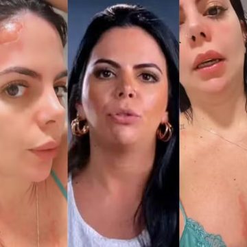 Grávida, Renata Giaffredo sofre queimaduras ao ser atingida por explosão de panela de pressão