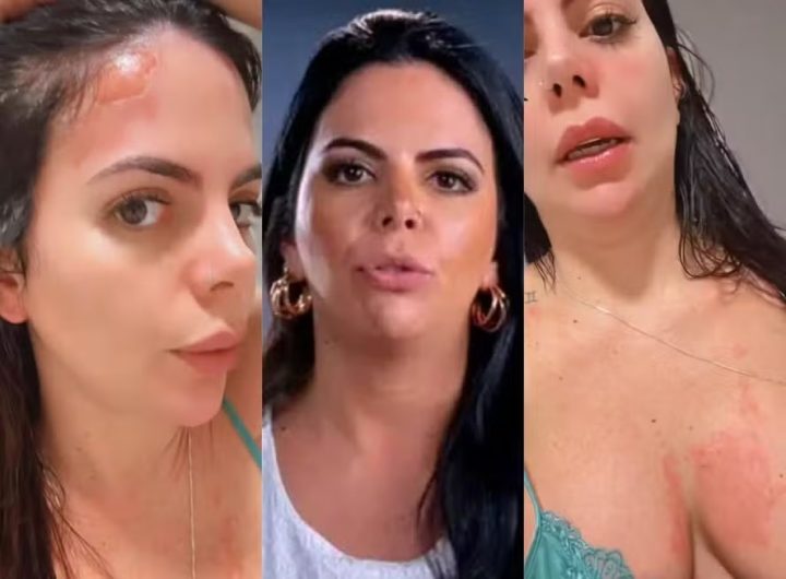 Grávida, Renata Giaffredo sofre queimaduras ao ser atingida por explosão de panela de pressão