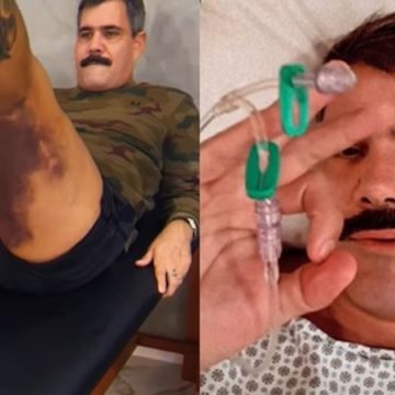 Juliano Cazarré exibe hematomas e comenta sobre recuperação após duas cirurgias