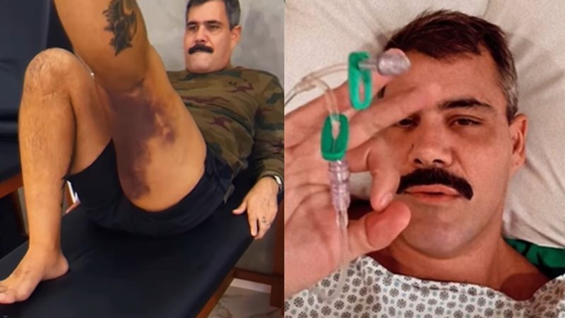 Juliano Cazarré exibe hematomas e comenta sobre recuperação após duas cirurgias