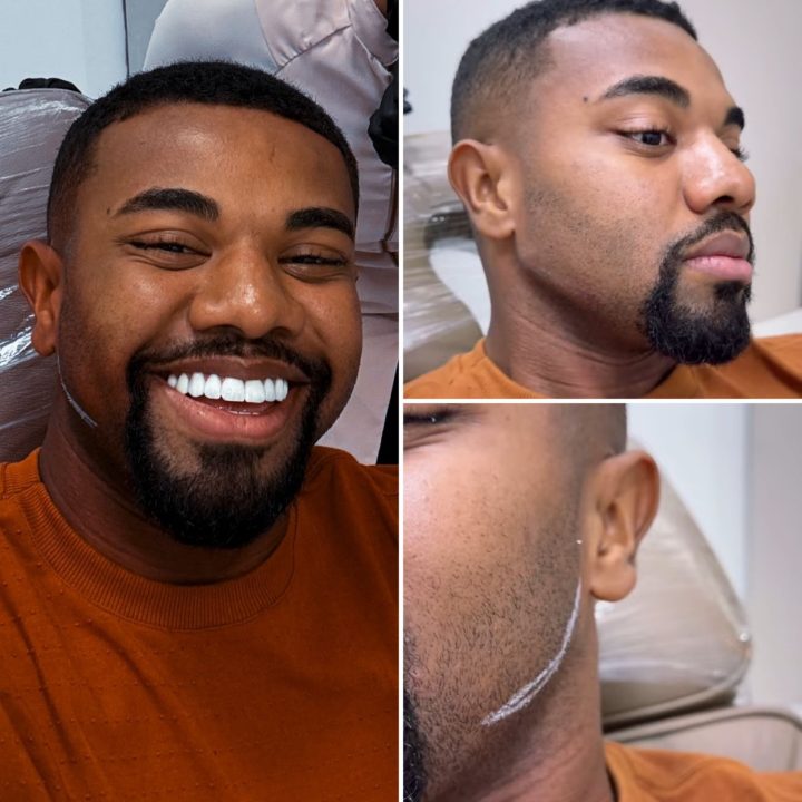 Davi Brito passa por harmonização facial e exibe resultado nas redes sociais; confira
