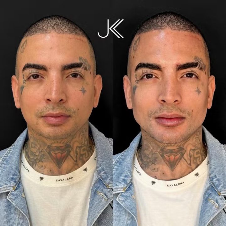 MC Guime mostra resultado de harmonização facial: “Achei que ficou natural”