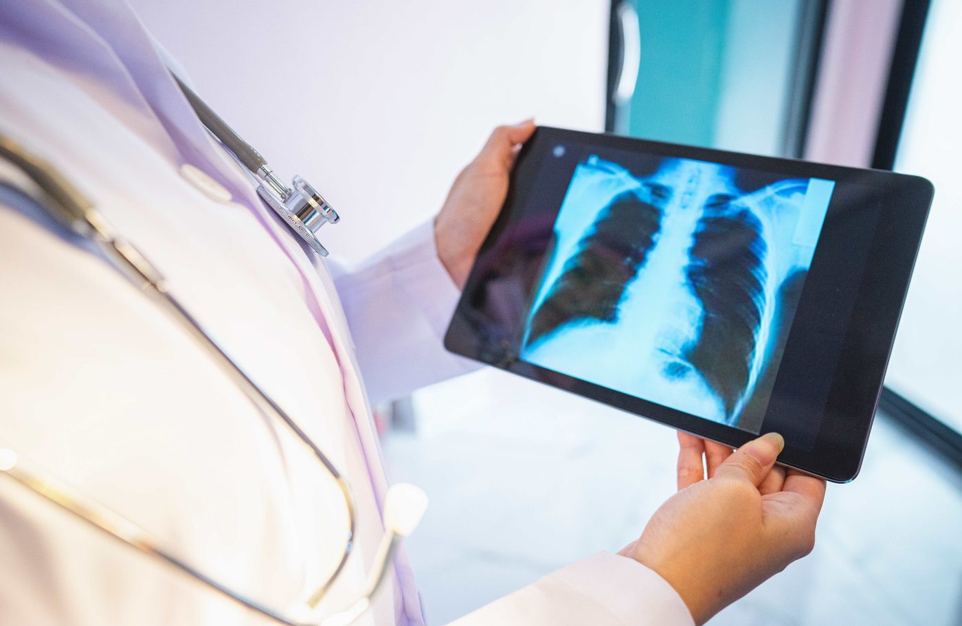 Novo estudo oferece esperança para pacientes com câncer de pulmão em estágio avançado, afirma oncologista baiana