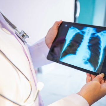 Novo estudo oferece esperança para pacientes com câncer de pulmão em estágio avançado, afirma oncologista baiana