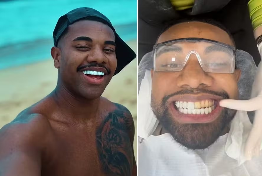 Davi Brito se arrepende e troca lentes de contato dos dentes: ‘Muito grande’