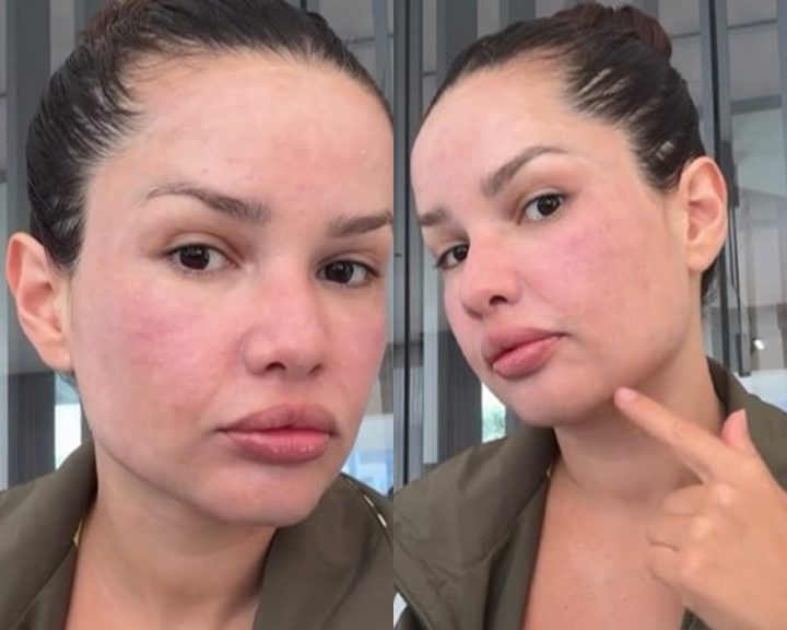 Juliette exibe rosto inchado após procedimento com esperma de salmão