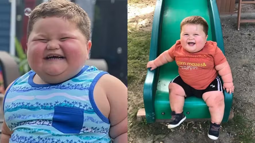 Criança de 3 anos pesava 45 quilos por causa de doença rara que o fazia chorar de fome o dia todo