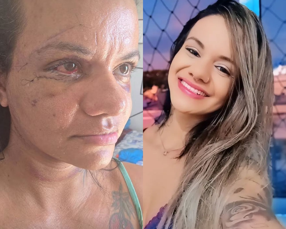 Mulher espancada em Natal mostra rosto pela primeira vez após cirurgia de reconstrução facial