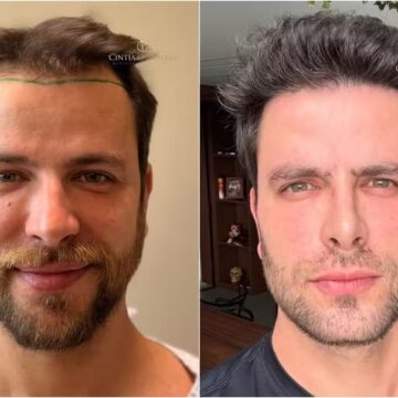 Ex-BBB Gustavo Marsengo celebra resultado de transplante capilar às vésperas do casamento com Laís Caldas