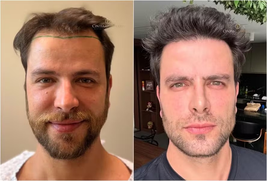 Ex-BBB Gustavo Marsengo celebra resultado de transplante capilar às vésperas do casamento com Laís Caldas