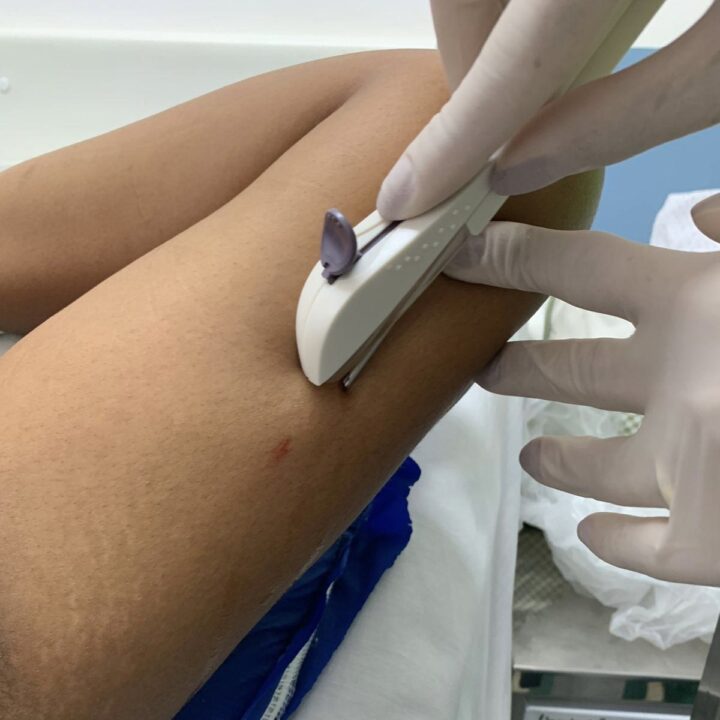 Salvador oferece implante contraceptivo gratuito em unidades de saúde; veja quem pode receber