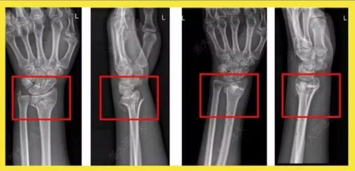 China anuncia revolução na ortopedia com ‘supercola óssea’ que resolve fraturas ‘em minutos’