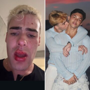 Caio Cerqueira surge sujo de sangue após ser acusado de agredir namorado em Paris