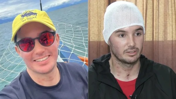 Motoboy que ficou cego após beber uísque com metanol tem alta após 45 dias