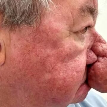 Escocês com nariz gigante faz cirurgia para poder voltar a beijar a esposa