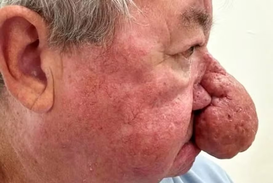 Escocês com nariz gigante faz cirurgia para poder voltar a beijar a esposa