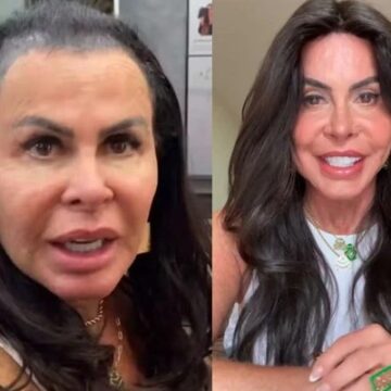 Gretchen desabafa após diagnóstico de alopecia: ‘Não tenho mais cabelo’ Gretchen desabafa após diagnóstico de alopecia: ‘Não tenho mais cabelo’