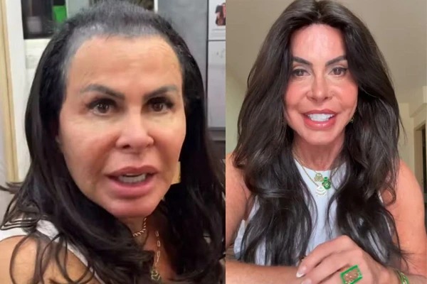 Gretchen desabafa após diagnóstico de alopecia: ‘Não tenho mais cabelo’ Gretchen desabafa após diagnóstico de alopecia: ‘Não tenho mais cabelo’