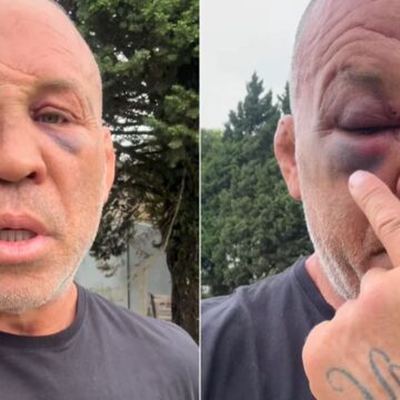Wanderlei Silva posta vídeo, mostra fraturas e diz que buscará justiça: “ato criminoso”