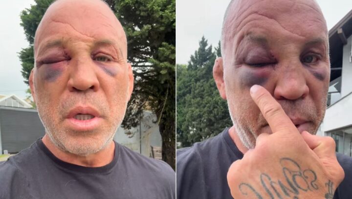 Wanderlei Silva posta vídeo, mostra fraturas e diz que buscará justiça: “ato criminoso”