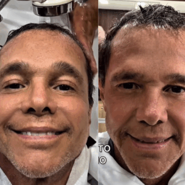 Netinho mostra retorno do crescimento capilar após enfrentar câncer