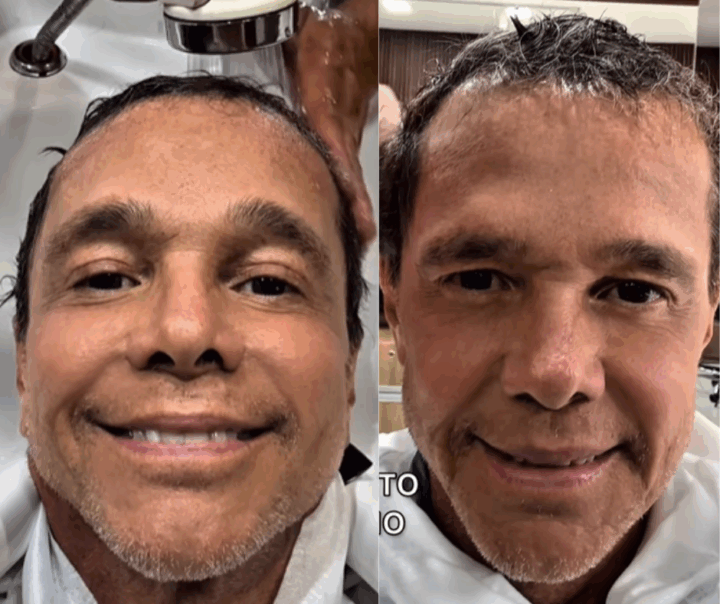 Netinho mostra retorno do crescimento capilar após enfrentar câncer