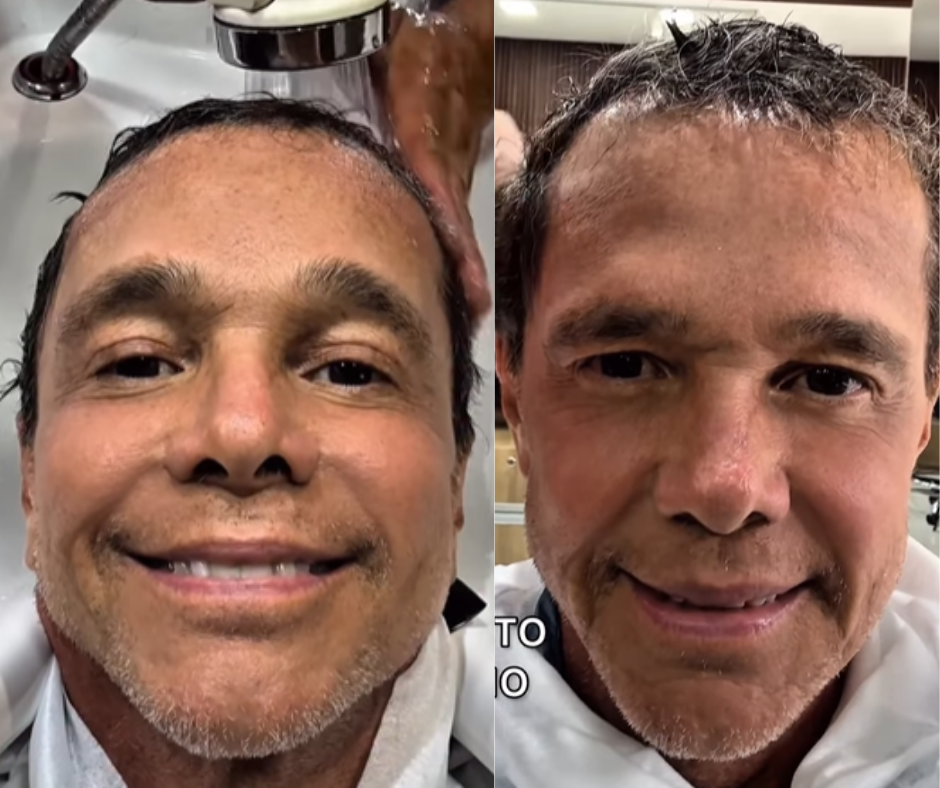 Netinho mostra retorno do crescimento capilar após enfrentar câncer