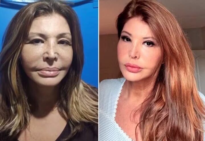 Roberta Close faz harmonização facial aos 60 anos