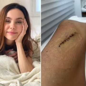 Flávia Monteiro fala sobre diagnóstico de câncer de pele: ‘Uma micro pinta era um melanoma’