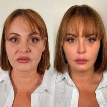 Gaby Spanic, a Usurpadora, mostra antes e depois após rejuvenescimento facial