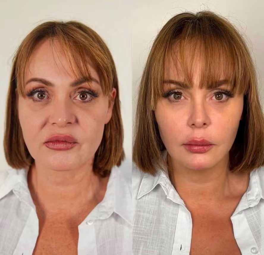 Gaby Spanic, a Usurpadora, mostra antes e depois após rejuvenescimento facial