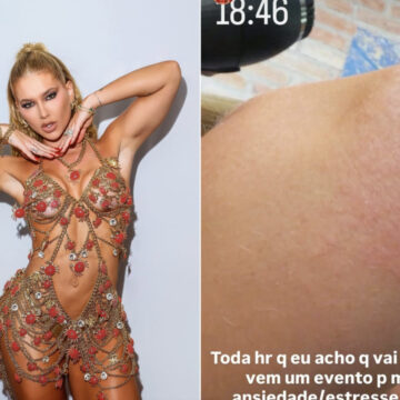 Virgínia Fonseca mostra reação alérgica e desabafa: ‘Ansiedade e estresse’