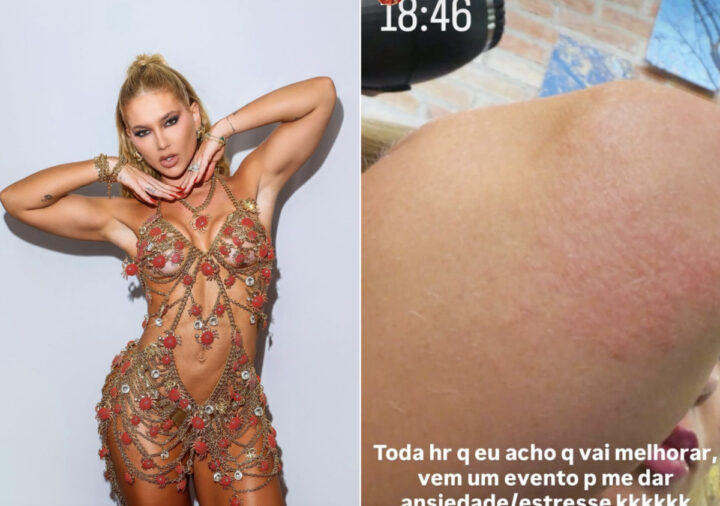 Virgínia Fonseca mostra reação alérgica e desabafa: ‘Ansiedade e estresse’