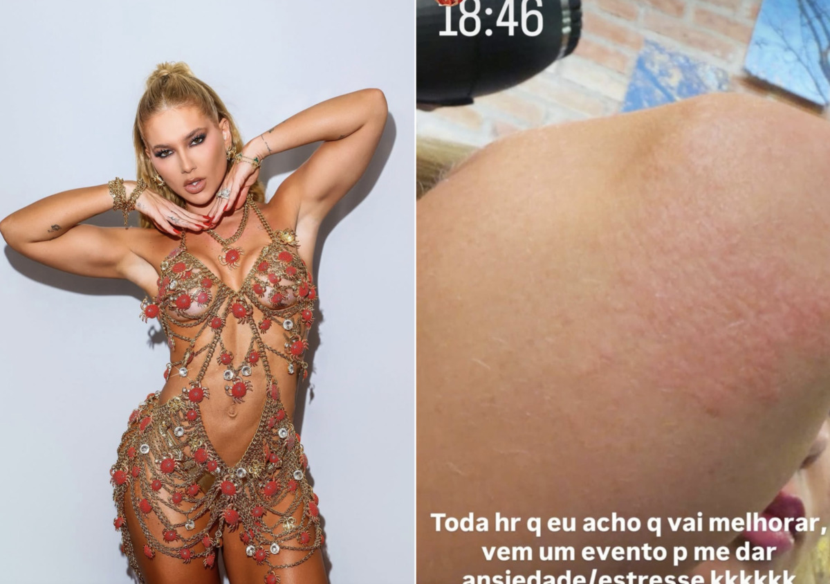 Virgínia Fonseca mostra reação alérgica e desabafa: ‘Ansiedade e estresse’