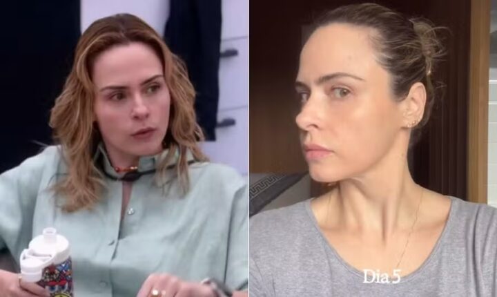 BBB 26: Ana Paula fez procedimentos estéticos no rosto um mês antes do programa; veja quais