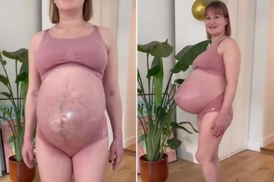 Grávida de trigêmeas com barriga pontuda viraliza nas redes sociais: ‘É incrível!’
