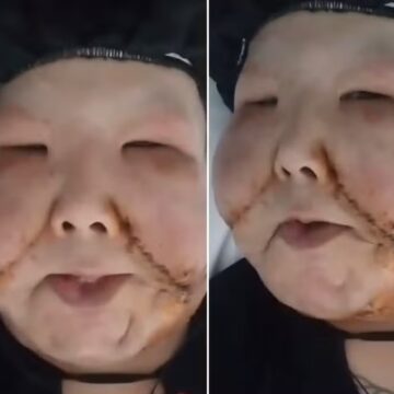 Juju do Pix celebra 2ª cirurgia para retirada do óleo mineral do rosto: ‘Do jeito que eu queria’