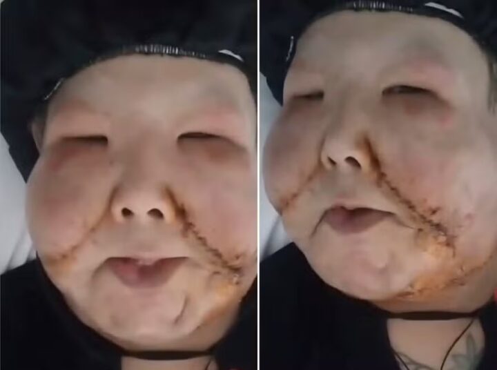 Juju do Pix celebra 2ª cirurgia para retirada do óleo mineral do rosto: ‘Do jeito que eu queria’