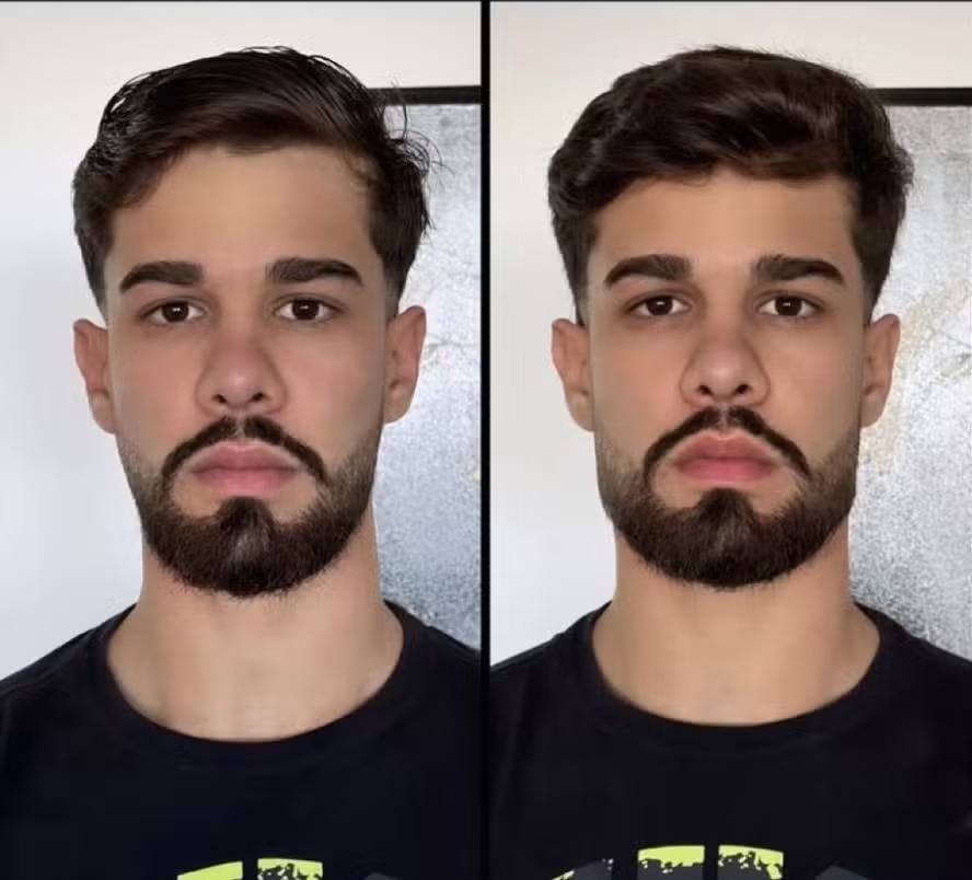 Paulo Augusto, do BBB 26, passou por harmonização facial para definir a mandíbula; veja antes e depois